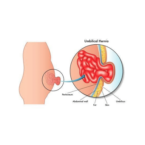 Una hernia umbilical se produce cuando una parte del intestino delgado o el tejido graso sobresale a través de un área debilitada en la pared abdominal cerca del ombligo.